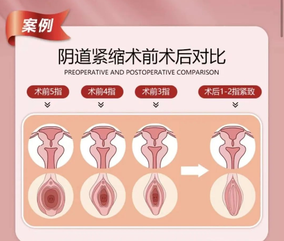 陰道鬆弛自測指南:了解陰道鬆弛程度