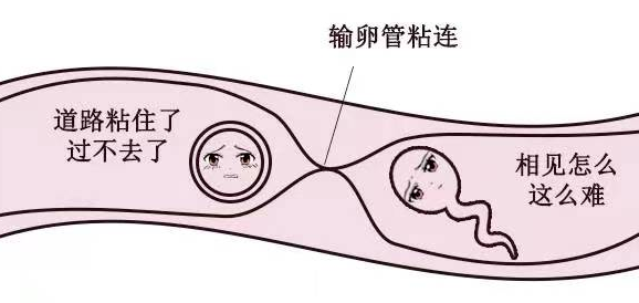 16017730.png 输卵管粘连.png