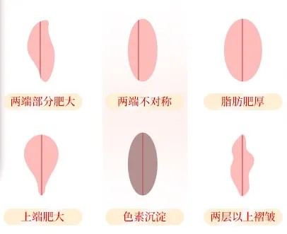 什么樣的小陰唇才需要手術?看圖對照下自己的