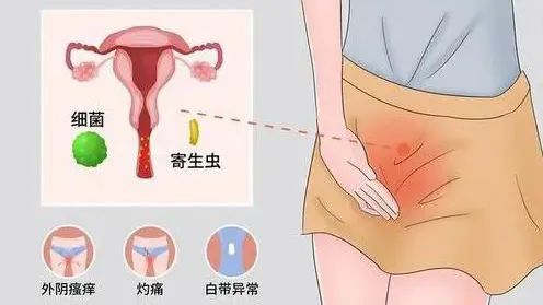 99356892.jpg 婦科炎症.jpg